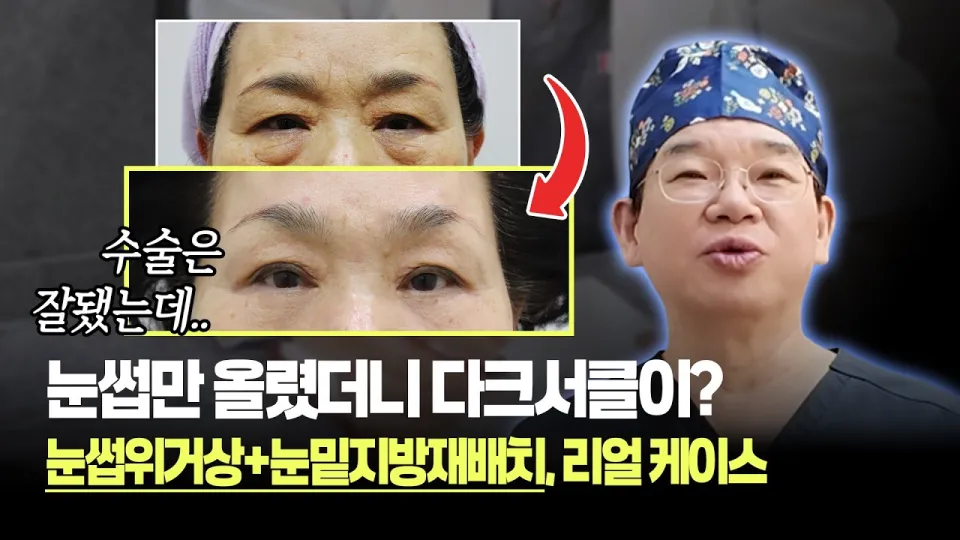 눈썹위거상 효과와 관리 방법 1년 이후 변화까지 완벽 가이드